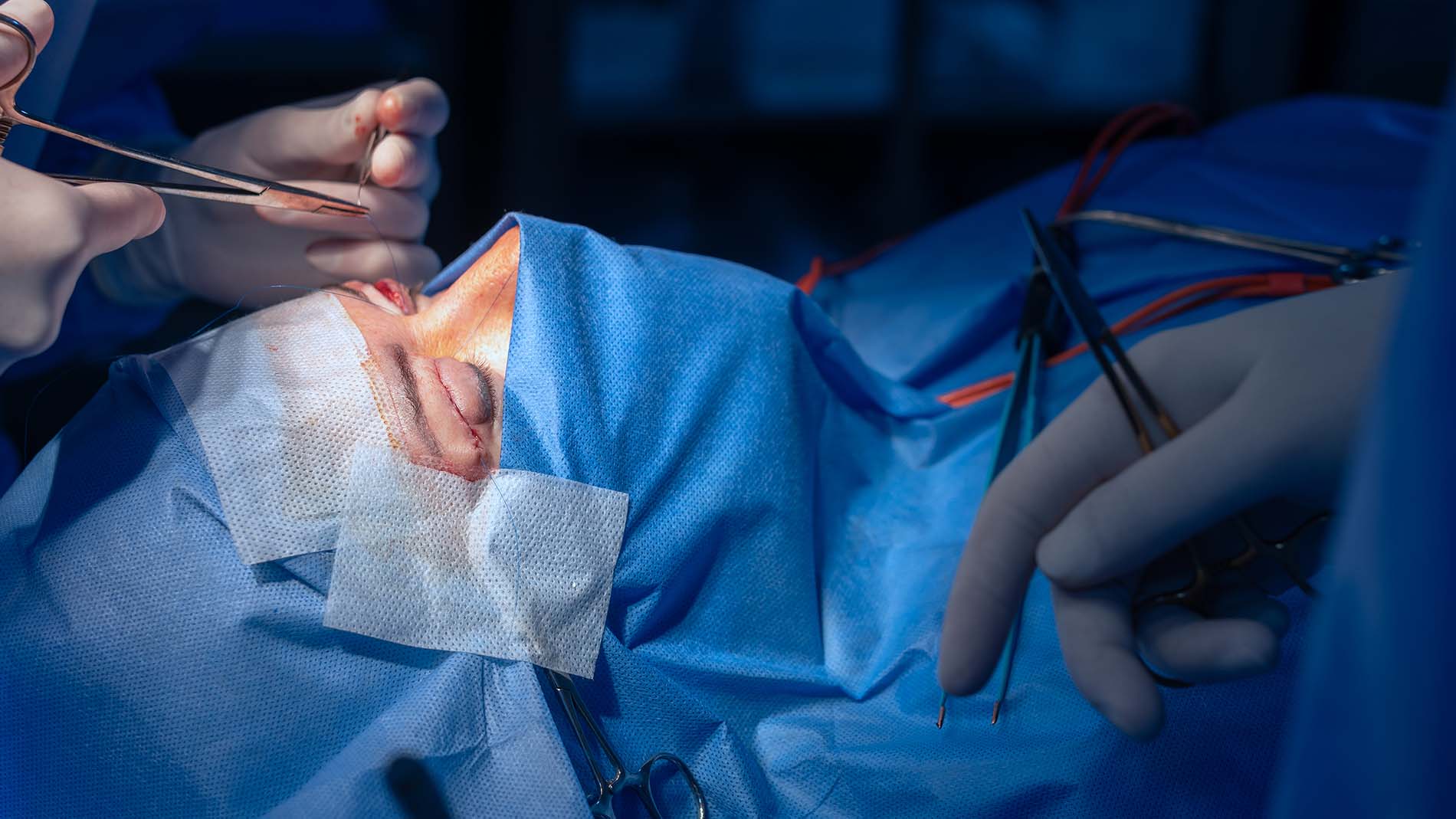 Doctores realizando cirugía de párpados