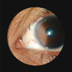 Fotografía de ojo con neoplasia escamosa de superficie ocular visto de cerca