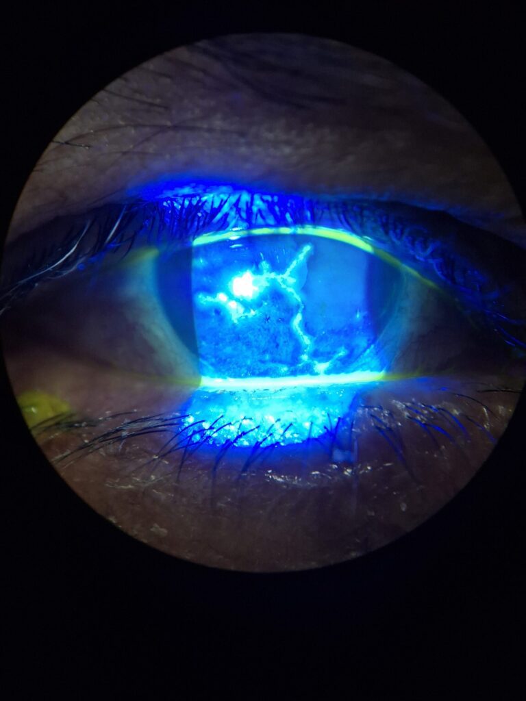 enfermedad clínica, fotografía de herpes ocular para su estudio