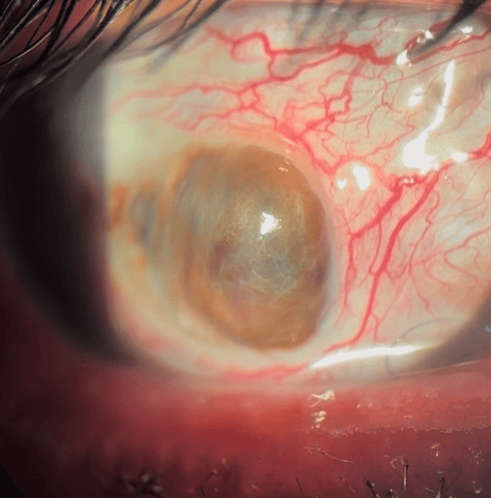 Ojo con lisis colgajo conjuntival, mostrado en imagen clínica oftalmológica