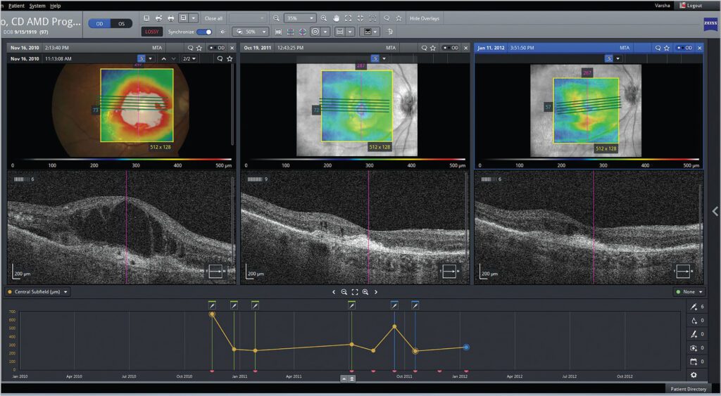 Pantalla dividida en tres secciones que compara escaneos maculares de un paciente en diferentes fechas mediante imágenes OCT y mapas de grosor retinal, acompañadas de gráficas de evolución clínica en el tiempo.