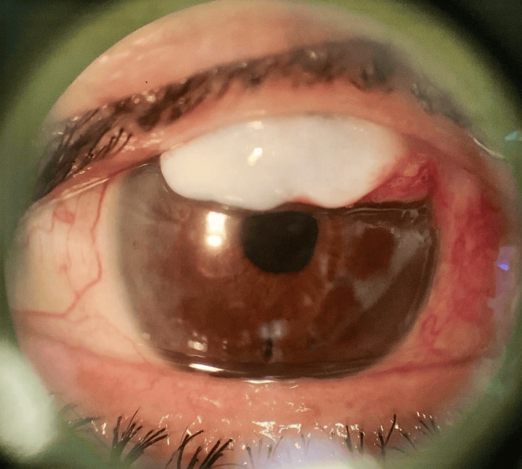 Ampolla en ojo mostrada en fotografía clínica para estudio de enfermedades oculares, enfocado en tratamiento de trabeculoplastia láser selectiva (SLT)