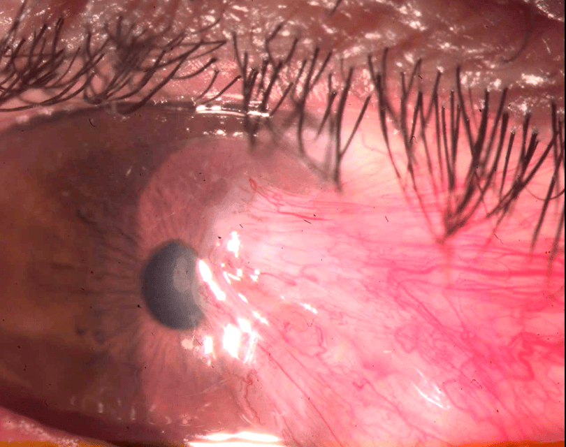 Imagen clínica que muestra el pterigión o carnosidad ocular avanzando desde el lagrimal hacia la córnea, con tejido rojo e inflamado.