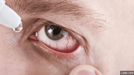Se observa en primer plano el ojo irritado de un hombre, mientras éste aplica gotas para ojo seco, en el contexto de un estudio sobre célula caliciforme y ojo seco