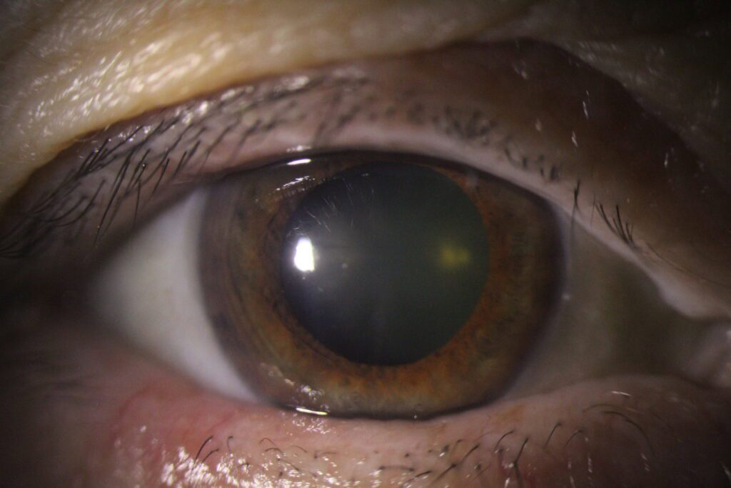 Imagen clínica de un ojo humano con catarata avanzada, utilizada en el contexto del artículo sobre el tratamiento combinado de una semana con levofloxacino y dexametasona previo a cirugía de cataratas. Ilustra la opacidad del cristalino y apoya la comprensión visual del enfoque terapéutico innovador propuesto.