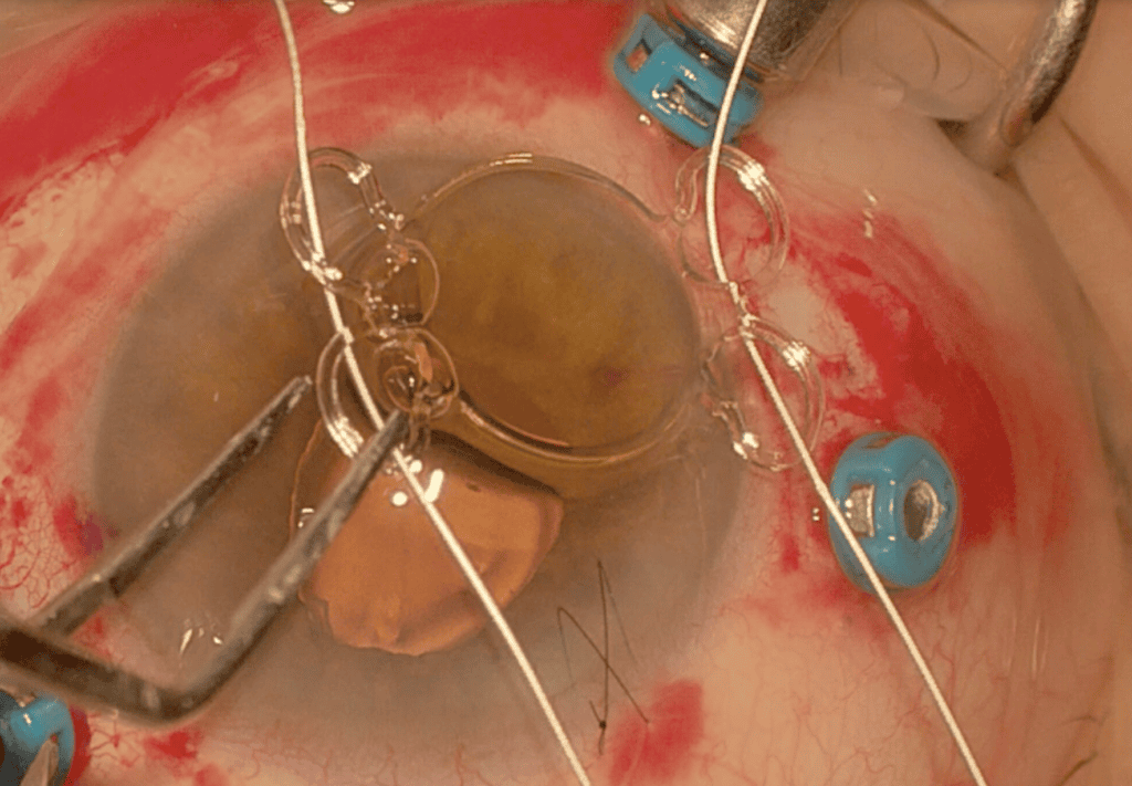 Lente intraocular con 4 puntos de fijación para sutura a esclera con GORE-TEX.