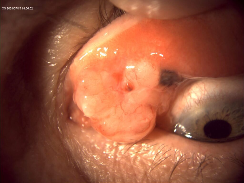 El enemigo de la superficie ocular: melanoma de conjuntiva