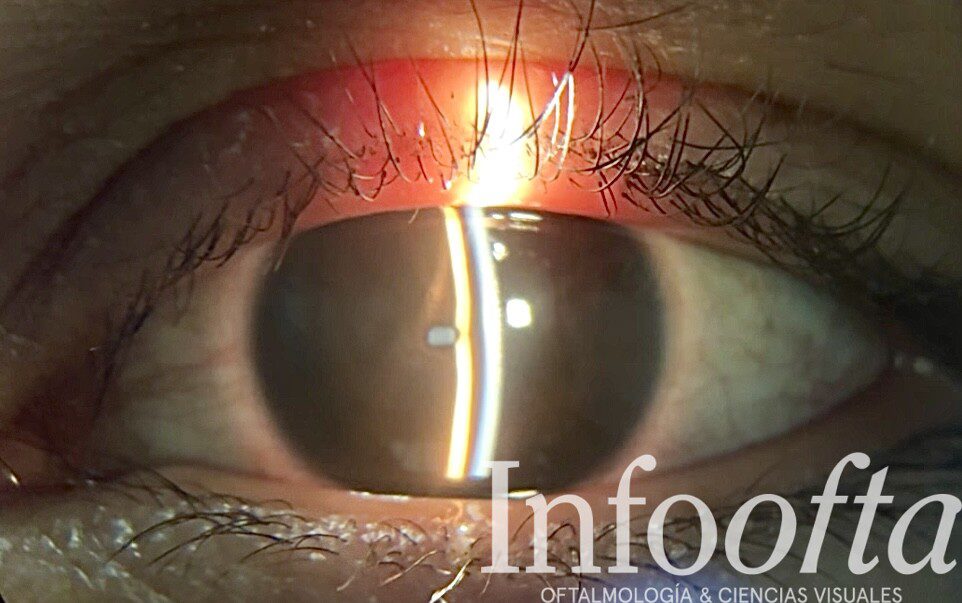 Fotografia-clinica-del-mes_Vol.8_Microcoria