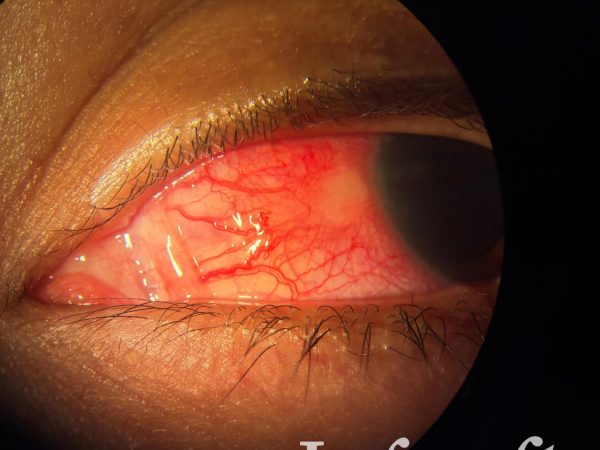 Fotografía clínica del mes_Vol.11_Escleritis nodular anterior