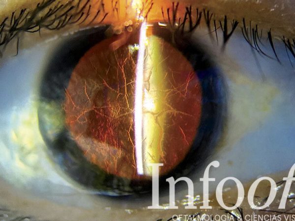 distrofia corneal, imagen clínica con técnica de retroiluminación